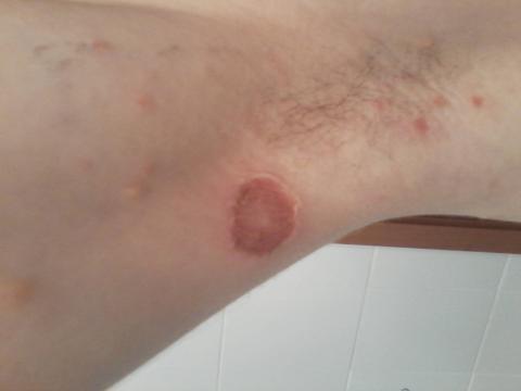 Červené vyrážky pod pazuchou